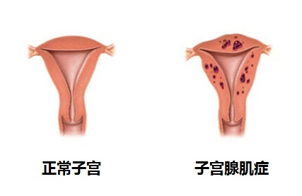 腺肌症应该怎么治疗